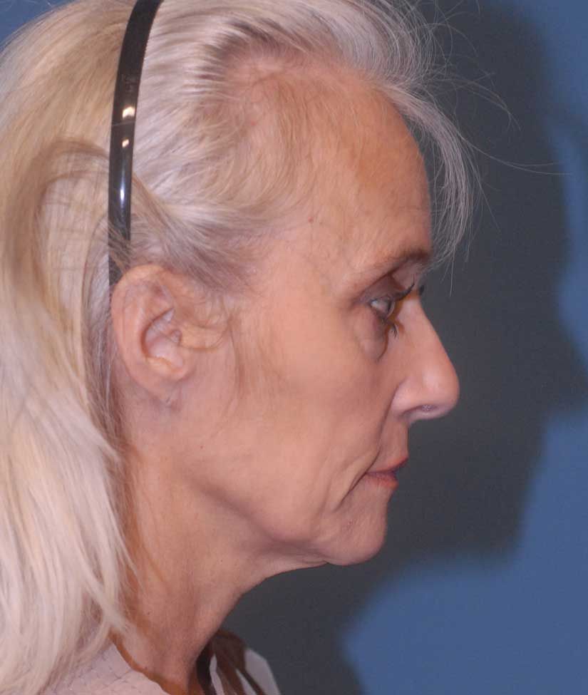 Face Resurfacing Before & After