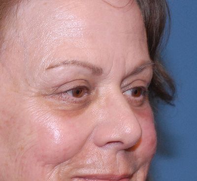 Face Resurfacing Before & After