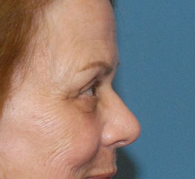 Face Resurfacing Before & After