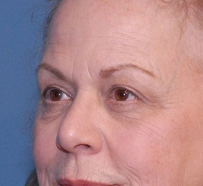 Face Resurfacing Before & After