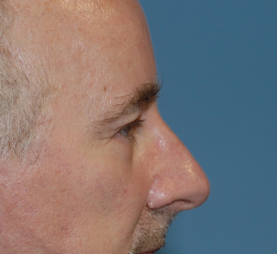 Blepharoplasty Before & After