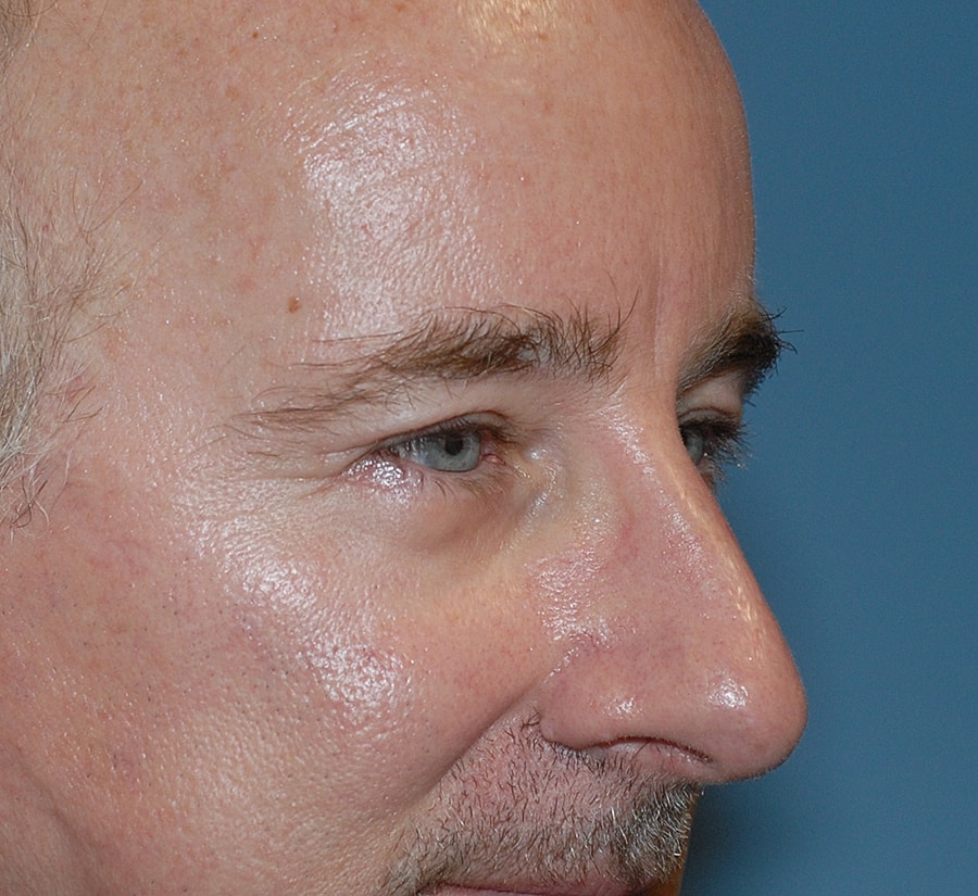 Blepharoplasty Before & After