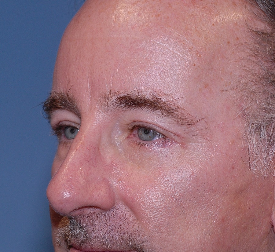 Blepharoplasty Before & After