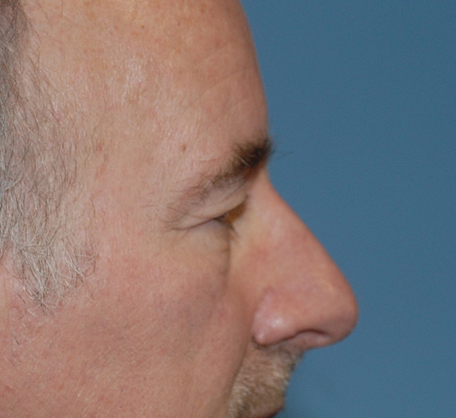 Blepharoplasty Before & After