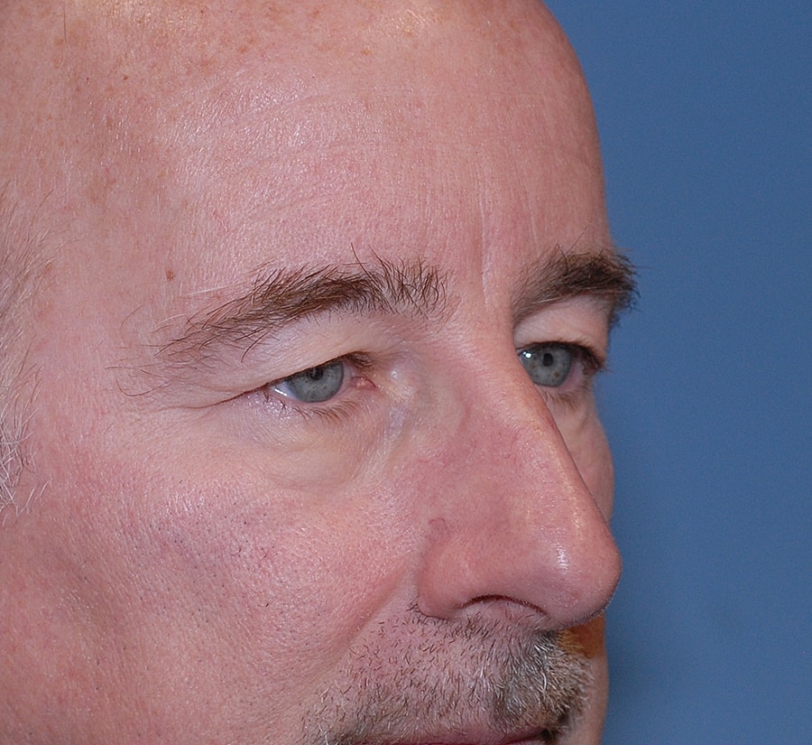 Blepharoplasty Before & After