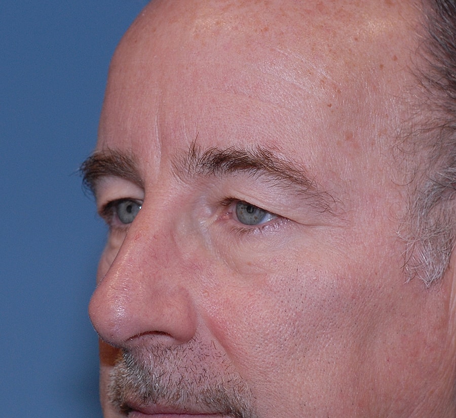 Blepharoplasty Before & After