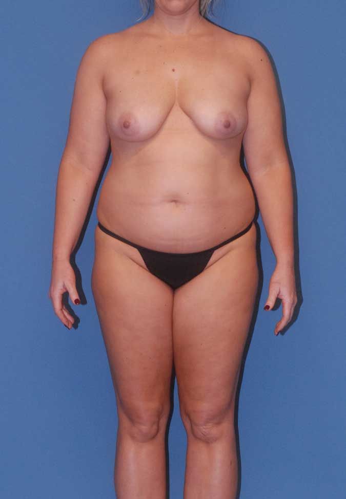 Thigh Lift Before & After