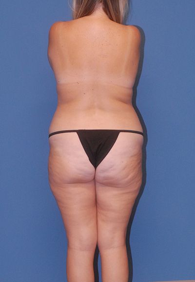Breast Lift Before & After