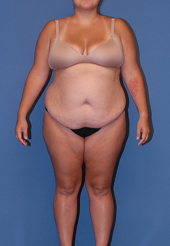 Breast Lift Before & After