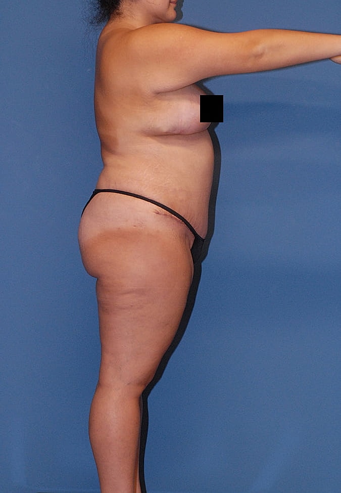 Breast Lift Before & After