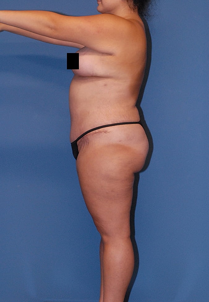 Breast Lift Before & After