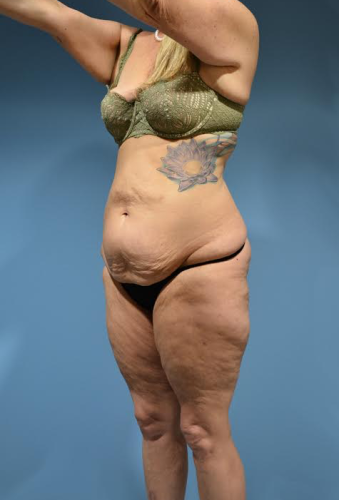 Body Lift Before & After