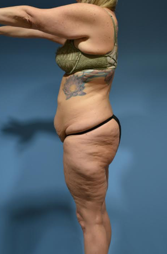 Body Lift Before & After