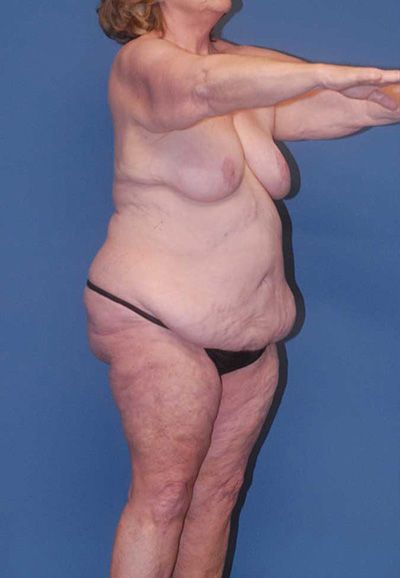 Body Lift Before & After