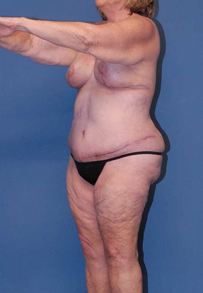 Body Lift Before & After
