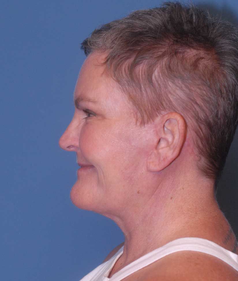 Liposuction Face Before & After