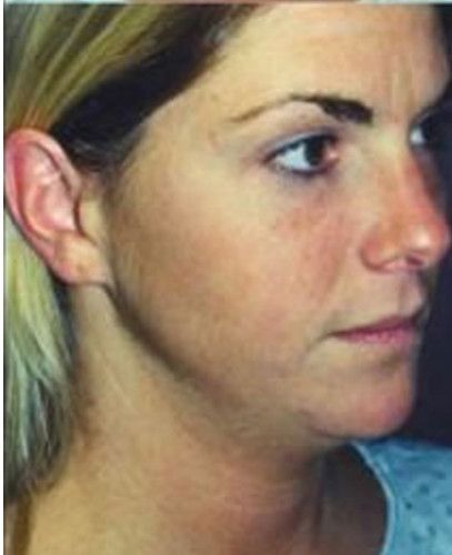 Liposuction Face Before & After