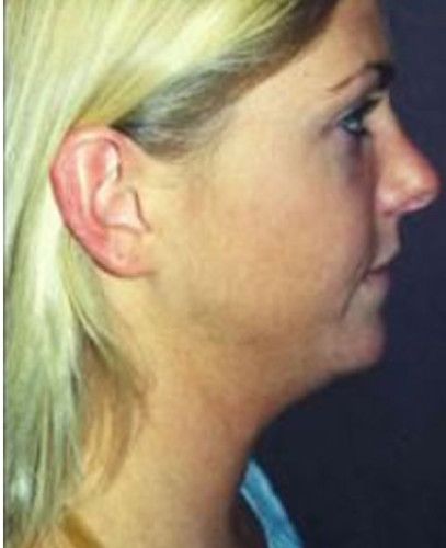 Liposuction Face Before & After