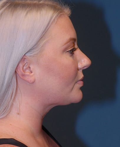 Liposuction Face Before & After