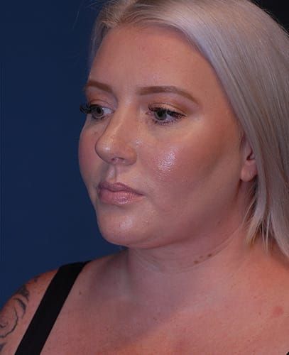 Liposuction Face Before & After