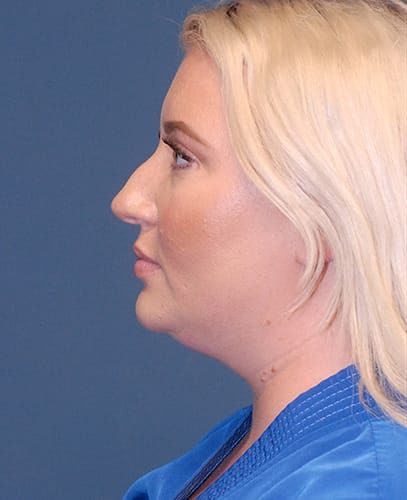 Liposuction Face Before & After