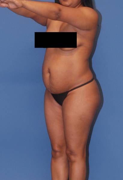 Fortes Figure Before & After