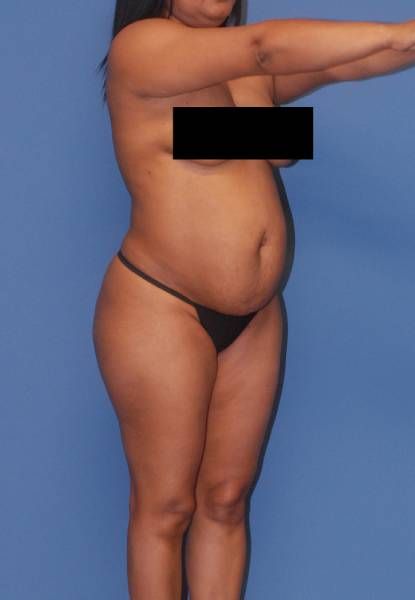 Fortes Figure Before & After