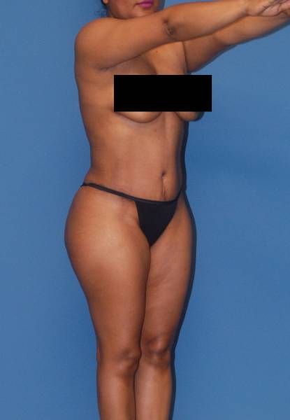 Fortes Figure Before & After