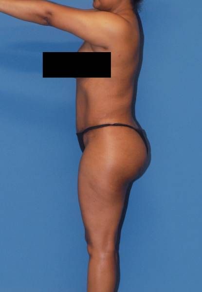 Fortes Figure Before & After