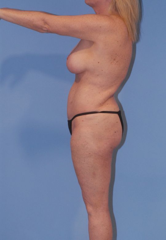 Fortes Figure Before & After