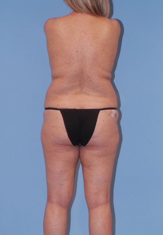 Fortes Figure Before & After