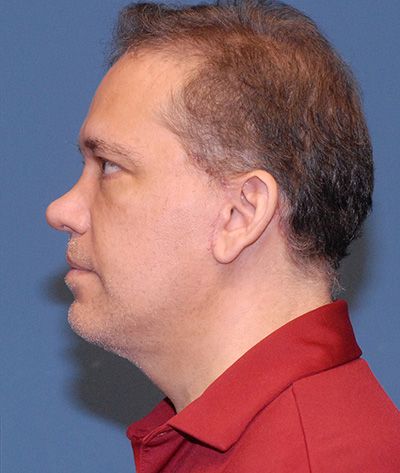 Blepharoplasty Before & After