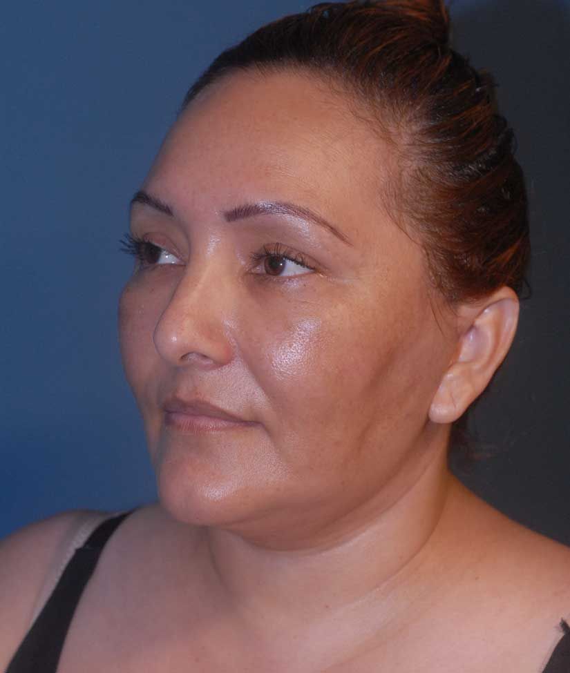Female Facial Rejuvenation Before & After