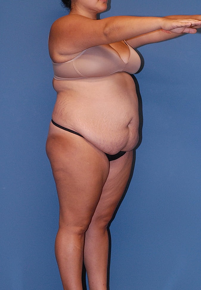 Mommy Makeover Before & After