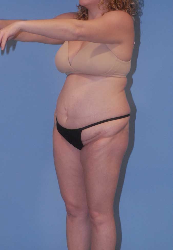 Liposuction Before & After