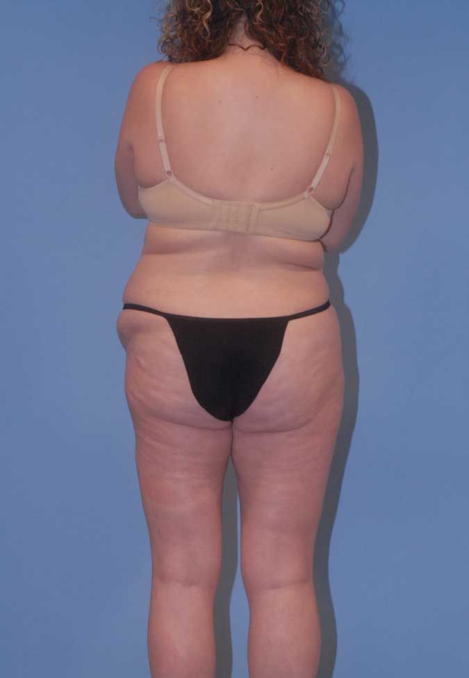 Liposuction Before & After