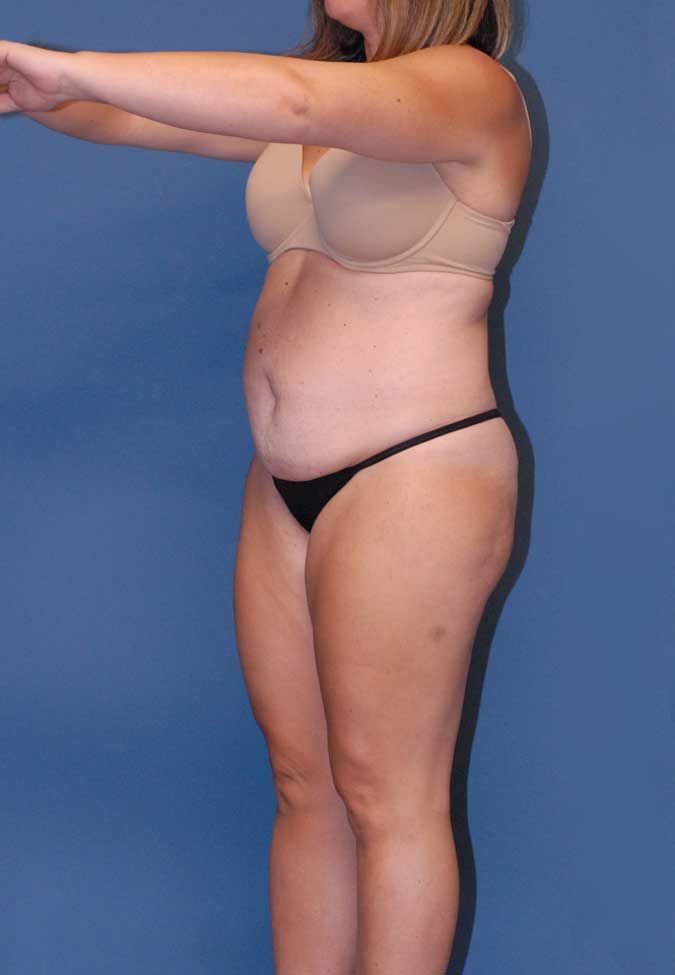 Liposuction Before & After