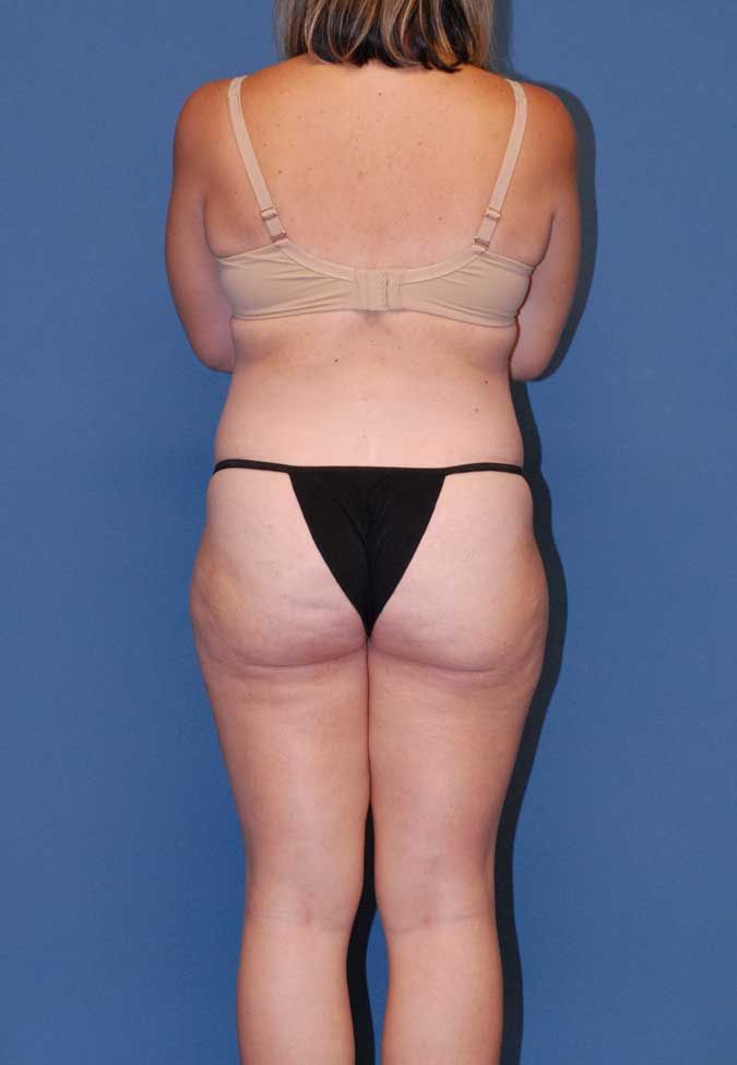 Liposuction Before & After