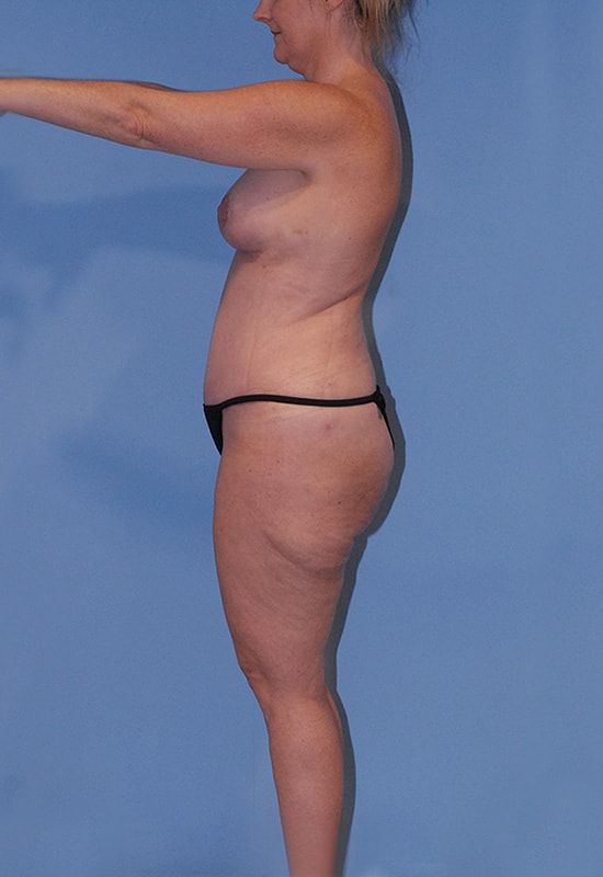 Liposuction Before & After