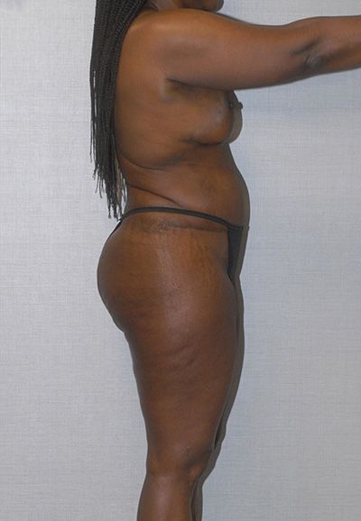 Liposuction Before & After
