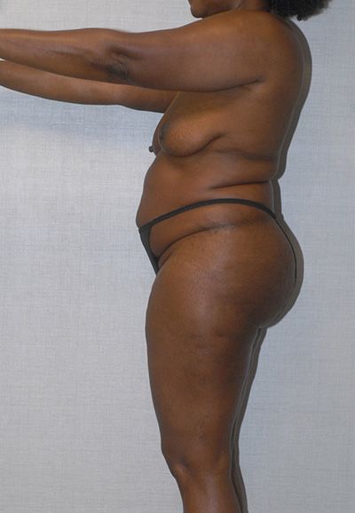 Liposuction Before & After