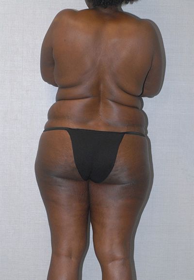Liposuction Before & After