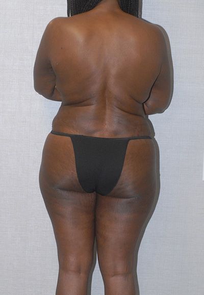 Liposuction Before & After