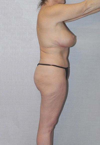 Liposuction Before & After