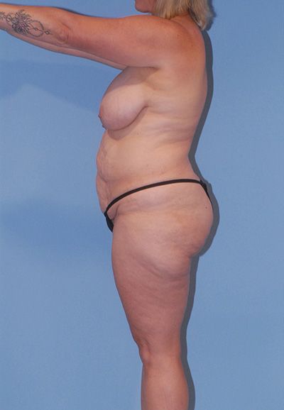 Liposuction Before & After
