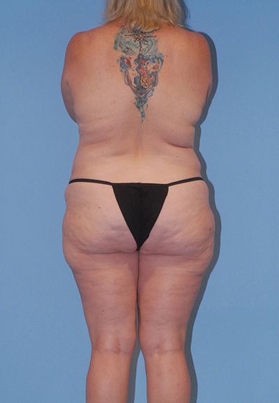 Liposuction Before & After