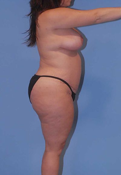 Liposuction Before & After