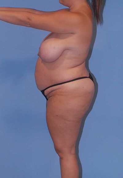 Liposuction Before & After