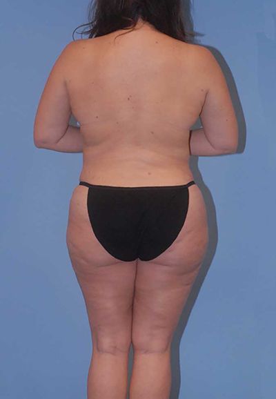 Liposuction Before & After