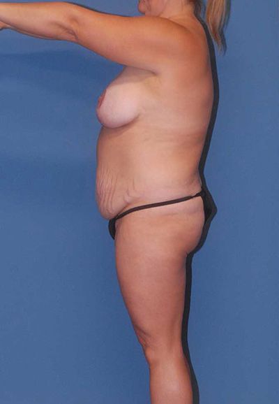 Liposuction Before & After